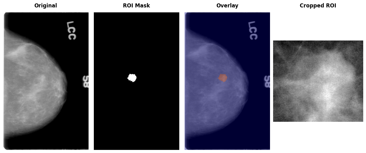 Four panels showing a mammogram, its region-of-interest mask, the mask overlaid on the mammogram, and the cropped region.