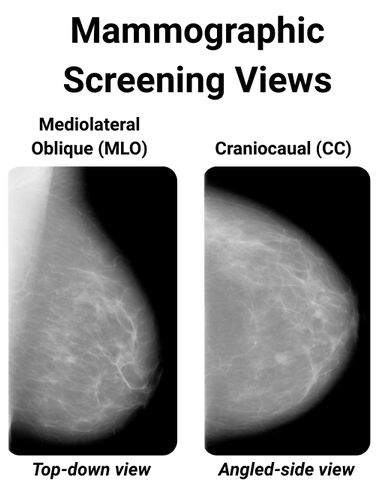 mammography-screen-views.png